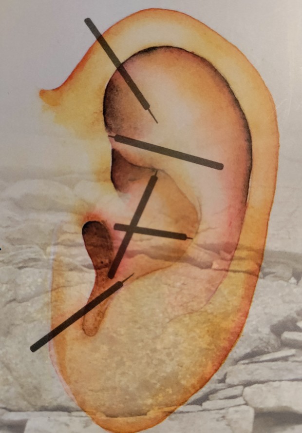 Read more about the article 11. forløb med øre-akupunktur på Sandvejen